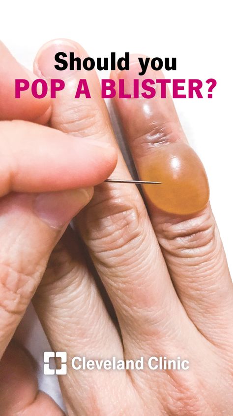 Should you pop or break a blister? How To Treat Blisters, Water Blister, Sunburn Blisters, Blister Remedies, Blister On Lip, How To Heal Blisters, Blister Care, Blood Blister, Skin Blisters