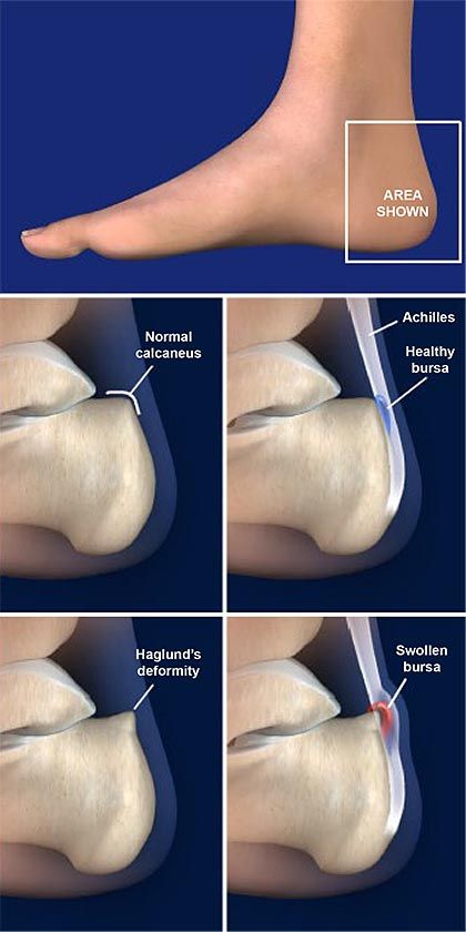 arthritis in the foot surgery 
triple arthrodesis procedure Triple Bypass Heart Surgery Recovery, Ablation Surgery Heart, Haglunds Deformity Surgery, Laparoscopic Surgery Instruments, Aortic Valve Replacement Surgery, Surgery, Florida, Health