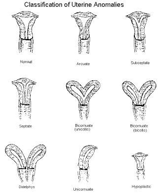 Bernardeena: The difference between a uterus bicornis bicollis and a uterus didelphys Bicornuate Uterus, Diagnostic Medical Sonography Student, Ultrasound School, Obstetric Ultrasound, Vascular Ultrasound, Sonography Student, Medical Sonography, Ultrasound Sonography, Medical Ultrasound