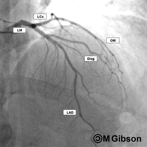 Angiography Heart, Coronary Angiography, Cath Lab Nursing, Cardiac Cath, Cath Lab Nurse, Arteries Anatomy, Medical School Interview, Cardiology Nursing, Interventional Cardiology