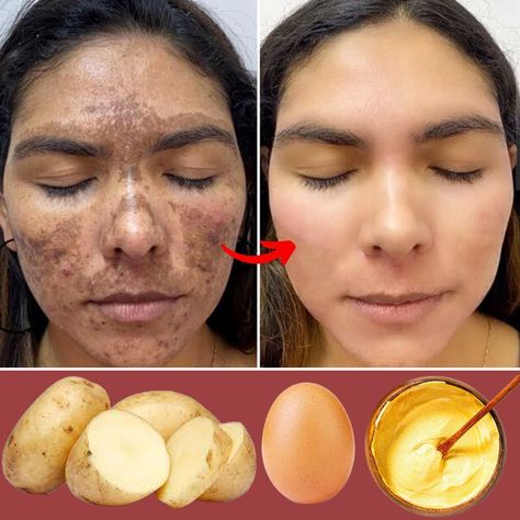 Potato Face Mask, Potato Face, Natural Skin Care Ingredients, Skin Face Mask, Dark Spots On Face, Natural Skin Care Remedies, Diy Skin Care Routine, Natural Face Skin Care, Skin Renewal