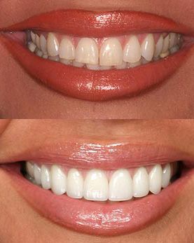 cosmetic dentist porcelain veneers Teeth Makeover, Toothache Relief, Zoom Teeth Whitening, Pretty Teeth, Veneers Teeth, Teeth Whitening Remedies, Beautiful Teeth, Laser Teeth Whitening, Porcelain Veneers