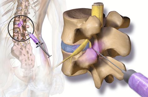 Nerve Ablation, Ablation Surgery, Neck Headache, Decompression Therapy, Occipital Neuralgia, Spinal Decompression, Chronic Lower Back Pain, Spinal Nerve, Spine Surgery