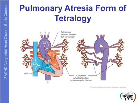 Pediatric Cardiac Sonography, Pediatric Cardiac Nursing Congenital Heart Defect, Cardiac Dysrhythmias, Tetralogy Of Fallot Heart, Zimbabwe Africa, Congenital Heart Defect Awareness, Ventricular Premature Contraction, Congenital Heart, Heart Defect