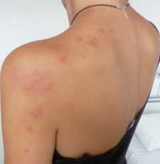 In this article we will review ways to get rid of bed bug bite marks. Bed Bug Bites Pictures, Stop Bug Bites From Itching, Anti Itch Remedy, Bed Bugs Bites Pictures, Bed Bug Prevention, Bug Bite Relief, Bug Bites Remedies, Bed Bug Spray, Kill Bed Bugs