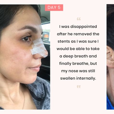 Rhinoplasty Recovery Timeline, Male Nose Job, Nose Job Recovery, Rhinoplasty Recovery, Nose Surgery Rhinoplasty, Bulbous Nose, Rhinoplasty Nose Jobs, Rhinoplasty Before And After, Aesthetic Dermatology