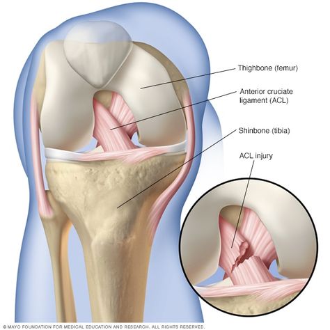 ACL injury - Symptoms and causes - Mayo Clinic Acl Recovery, Acl Injury, Acl Surgery, Anterior Cruciate Ligament, Ligament Tear, Acl Tear, Ligament Injury, Cruciate Ligament, Knee Pain Relief