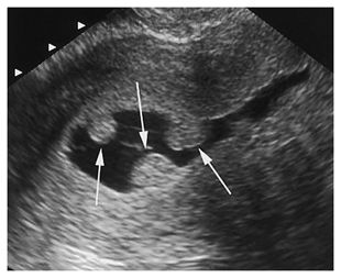 WK 3 L 2 Polyps seen with hysterosonography Polyps Uterus, Uterus Ultrasound, Enlarged Uterus, Gyn Ultrasound, Endometrial Carcinoma, Diagnostic Medical Sonography Student, Ultrasound School, Uterine Polyps, Obstetric Ultrasound