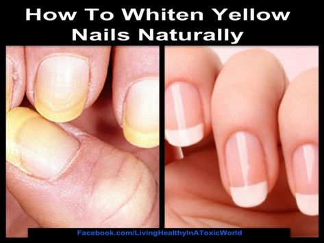 Make Nails White, Yellow Toe Nails, Stained Nails, Nail Whitening, Nail Remedies, Nail Base Coat, Yellow Nails Design, Gel Acrylic Nails, Living Healthy