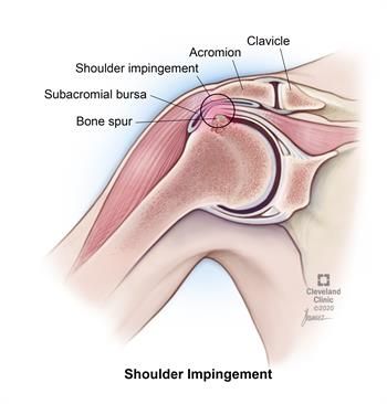 Shoulder Impingement Syndrome: Causes, Symptoms & Treatments Forward Head Posture Exercises, Rotator Cuff Tear, Shoulder Impingement, Rotator Cuff Injury, Shoulder Bones, Bicep Muscle, Forward Head Posture, Shoulder Surgery, Posture Exercises