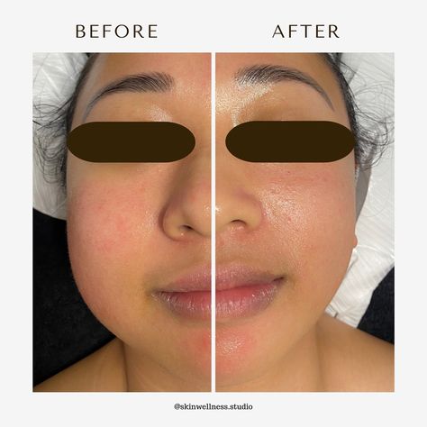 The power of facial lymphatic drainage + buccal massage 🌸 Our faces hold a lot of fluid throughout the day as the lymphatic system works to filter waste and toxins from tissues. When this delicate system becomes sluggish or overloaded, it can lead to puffiness and swelling around the eyes, jowls and cheeks that makes our skin appear tired and drawn. #transformationthursday #buccalmassage #mld #guasha #facialcupping #beforeandafter #puffyeyes #lymphaticdrainage #montreal #holisticesthetician... Buccal Massage, Facial Cupping, Puffy Eyes, Gua Sha, Esthetician, Montreal, Massage, Filter, Facial