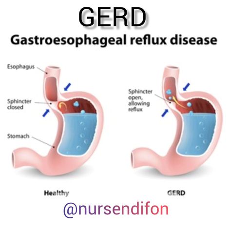 GERD, gastroesophageal Reflux Disease, is a chronic condition where stomach acid flows back up into the esophagus, causing irritation and inflammation. This happens when the lower esophageal sphincter (LES), a valve between the esophagus and the stomach, weakens or relaxes abnormally. Normally, the lower esophageal sphincter acts as a valve between the esophagus and the stomach, preventing stomach contents from flowing back up into the esophagus. In GERD, this sphincter becomes weak or relaxe... What Is Gerd, Gerd Symptoms, Natural Asthma Remedies, Asam Lambung, Stop Acid Reflux, Acid Reflux Recipes, Reflux Diet, Heart Burn Remedy, Acid Reflux Diet