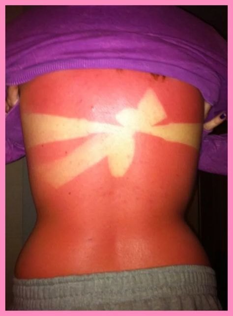 Sunburn Pictures, Funny Sunburn, Bad Sunburn, Epic Fails Funny, Tan Lines, Funny Fails, Best Funny Pictures, Funny Photos, Fails