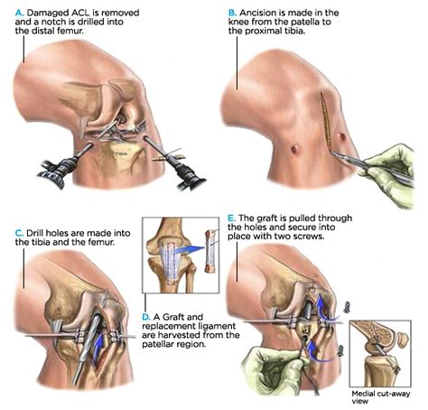 Acl Tear Recovery, Knee Anatomy, Meniscus Surgery, Acl Reconstruction Surgery, Knee Surgery Recovery, Knee Rehab, Acl Recovery, Acl Injury, Acl Surgery