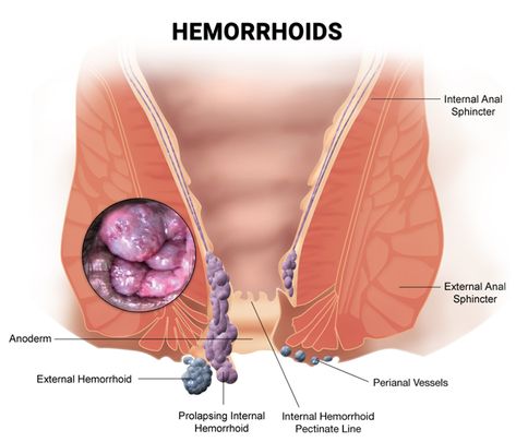 Discover if and when hemorrhoids go away on their own. Get insights on natural remedies and self-care for hemorrhoid relief. - #Canhemorrhoidshealnaturally #Canhemorrhoidsvanishnaturally #Canpilesresolvewithouttreatment #Canyoutreathemorrhoidswithoutintervention #Dohemorrhoidsdisappearontheirown #Dohemorrhoidshealbythemselves #Hemorrhoidself-care #Hemorrhoidself-healing... Hemorrhoid Remedies At Home, Hemorrhoid Relief Remedies, Hemroid Remedies How To Get Rid, Natural Remedy For Hemmoroids, Hemorrhoid Remedies How To Get Rid Of, Diy Hemorrhoid Relief Remedies, Hemroid Relief Fast, Hemmoroid Relief, External Hemmoroids