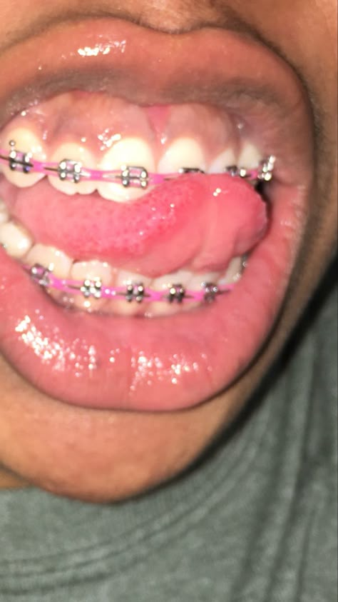 Dark Pink Braces, Pink Power Chain Braces, Chain Braces, Pretty Braces, Perfect Teeth Braces, Braces Aesthetic, Power Chain Braces, Braces Colours, Dental Braces Colors