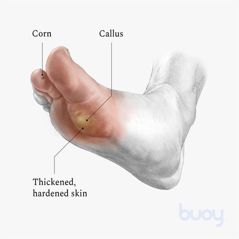 Foot Calluses | Why They Develop & How to Treat Them | Buoy Remove Callous From Foot, How To Remove Calluses From Foot, Callus Remover, Calluses On Feet Remedies, How To Get Rid Of Calluses On Feet Fast, Callus Remover Diy, Skin Blisters, Best Callus Remover, Wound Care Nursing