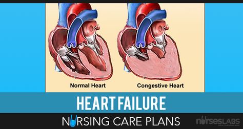 Heart Failure Care Plans Congestive Cardiac Failure, Nursing Documentation, Pediatric Nurse Practitioner, Study Info, Nurse Practitioner School, Nursing 101, Nursing Diagnosis, Nursing Care Plan, Best Nursing Schools