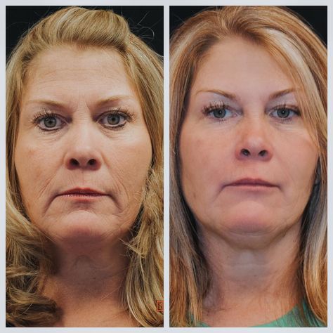 The Real Deal on Fillers - Lola Magazine Filler For Marionette Lines, Marionette Lines Before And After, Marionette Lines Filler, Juvederm Before And After, Lip Line Filler, Botox Wrinkles, Chin Filler, Marionette Lines, Plasma Pen