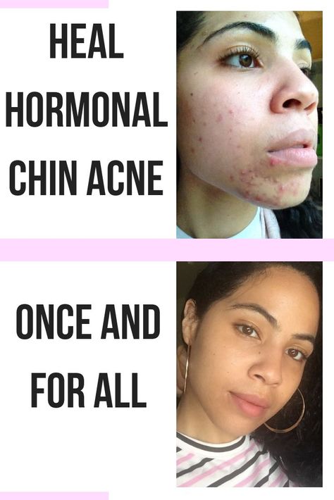 Whiteheads On Chin, Chin Whiteheads, Chin Acne Causes, Cystic Acne On Chin, Nodule Acne, Treating Cystic Acne, Chin Acne, Cystic Acne Remedies, Bad Acne