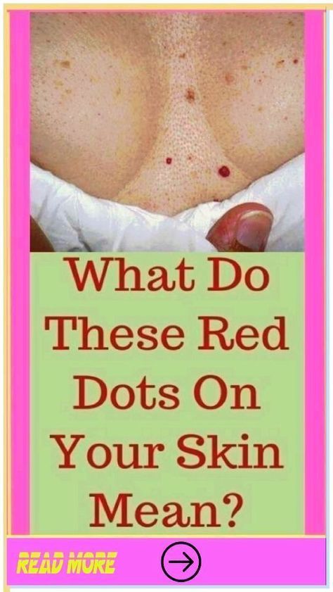 What Causes Pimples On Buttocks? 10 Effective Tips – DiyVines: Do It Yourself Bumps On Skin, Red Skin Spots, What Causes Pimples, Pimples On Buttocks, Redness Pimple, Skin Bumps, Keratosis Pilaris, Home Health Remedies, Health Trends