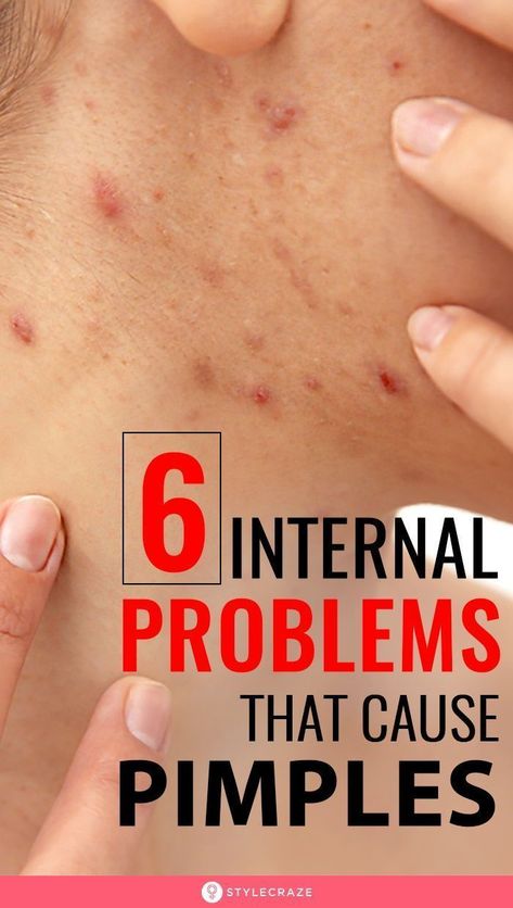 Cheek Pimples, What Causes Pimples, Cheek Acne, Painful Pimple, Pimple Causes, Blind Pimple, Pimples Under The Skin, Acne Overnight, Pimples Overnight