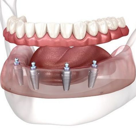 Don't let missing teeth affect your confidence and quality of life. Contact us today to schedule a consultation and learn more about how All-on-4 dental implants can transform your smile and boost your self-esteem.

Call us ☎️ (315) 864-5360
#AestheticOralArts #DentistNewHartford #AllOn4 #DentalImplants Dental Animation, Dental Implant Surgery, Medical Animation, Columbia City, Oral Surgeon, Missing Teeth, Dental Implant, Dentures, Quality Of Life