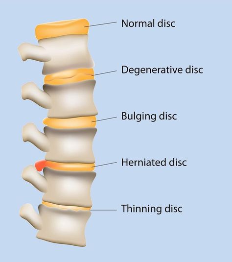 Lumbar degenerative disc disease (DDD) is defined simply as the wear and tear of the intervertebral disc, which may result from normal… Lumbar Disc, Intervertebral Disc, Bulging Disc, Disease Symptoms, Body Tissues, Nursing Notes, Health Logo, Like Comment Share, Doctor Medical