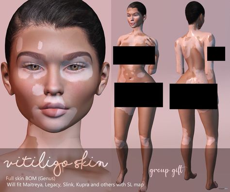 Sims 4 Cc Skin Conditions, The Sims 4 Cc Viltigo, Vitiglio Skin Sims 4, Sims 4 Vilitigo Cc, Sims 4 Cc Vitigilo, Sims 4 Vilitigo Skin, Vilitigo Skin Sims 4 Cc, Sims 4 Cc Vilitigo Skin Patreon, Sims 4 Cc Vilitigo Skin Details