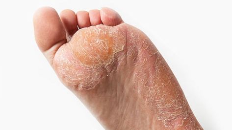 How to Get Rid of Hard Skin on Feet Quick Crusty Feet Dry Skin, How To Get Rid Of Calluses On Feet Fast, How To Get Rid Of Athletes Foot Fast, Dead Skin On Feet Removal, Pedicure Tips, Chin Hair, Dry Flaky Skin, Soft Smooth Skin, Crazy Facts