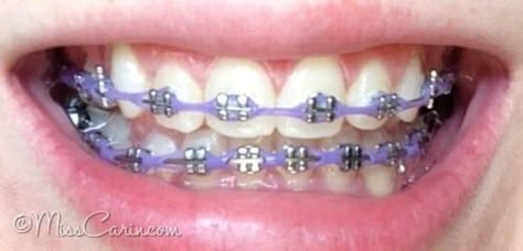 lilac/ lavender braces: power chain Braces Power Chain, Lavender Braces, Chain Braces, Power Chain Braces, Dental Braces Colors, Braces Colors Combinations, Invisible Teeth Braces, Braces Colors Ideas, Power Chain