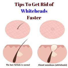 White Heads On Nose, Whiteheads Remedy, Pimples On Buttocks, Chin Acne, Pimples Under The Skin, Face Scrub Homemade, Acne Remedies, How To Get Rid Of Acne, The Nose