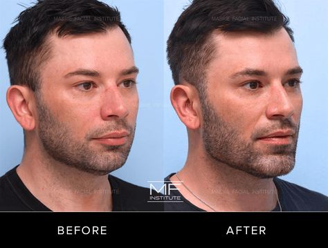 Case 726: Photos depicting a man before and after chin jawline dermal filler in San Francisco, CA Male Jaw Filler, Mens Jawline Filler, Jawline Before And After, Looksmaxxing Men, Jawline Fillers Before And After, Male Jawline, Jaw Filler, Liquid Rhinoplasty, Jawline Men