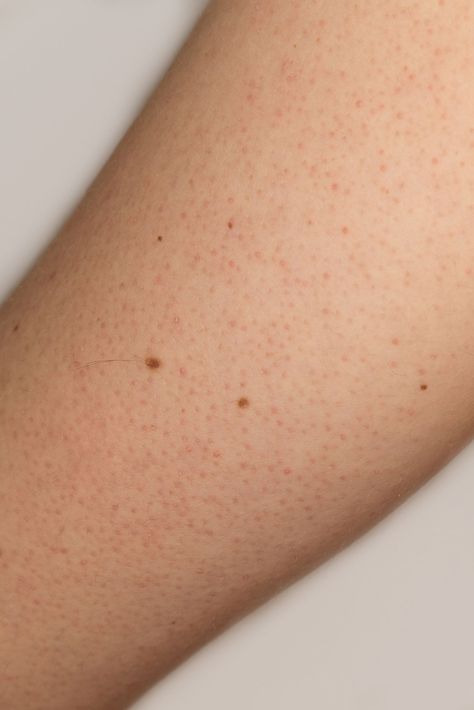 How to Clear Chicken Skin. Red Dots On Legs Skin, Red Dots On Skin, Black Dots On Face, Skin Problems Face, Dots On Face, Spots On Legs, Nail Problems, Face Pores, Brown Spots Removal