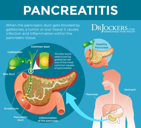 Pancreatitis: Symptoms, Causes and Natural Support Strategies Pancreatic Diet, Pancreatic Diet Recipes, Pancreas Health, Quadrants Of The Abdomen, Healthy Liver Diet, Healing Naturally, Low Stomach Acid, Liver Diet, Biology Facts