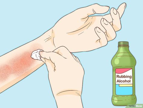 3 Ways to Treat Poison Ivy and Poison Oak - wikiHow Apple Cider Vinegar For Poison Ivy, Remedy For Poison Ivy Rash, Poison Ivy Bath Soak, How To Stop Poison Ivy Itching, Essential Oils For Poison Oak, How To Treat Poison Ivy, Stop Poison Ivy Itch, How To Get Rid Of Poison Oak, Natural Poison Ivy Remedy