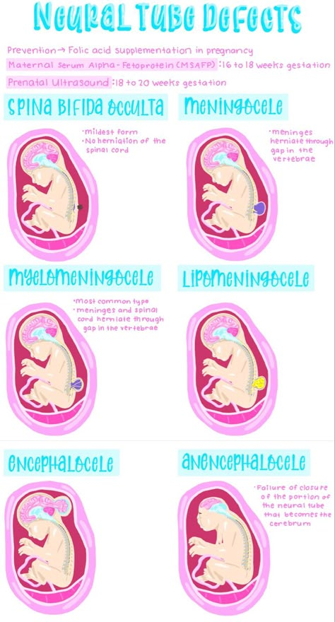 Neural tube defects Sonography Student Notes, Ultrasound Technician Notes, Ultrasound Technician Student Notes, Ultrasound Notes Study, Ultrasound Tech Notes, Sonography Student Study Obgyn, Sonography Notes, Obgyn Ultrasound Tech Aesthetic, Ultrasound Technician Student