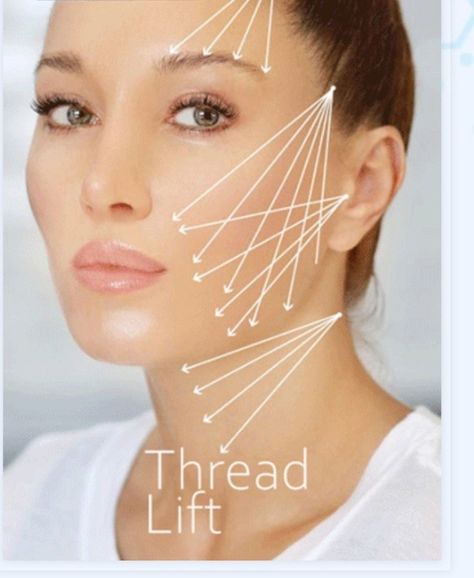 Thread Lift Face, Eyebrow Lift, Marionette Lines, Thread Lift, Tissue Types, Cosmetic Injectables, Face Lifting, Facial Plastic, Body Spa