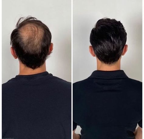 💰🤑💰20$ Coupon: INS 👉Check bio link for the hairpiece www.toupee.com 📩WhatsApp:+86 131 5629 1720 Simple Texture Background, Hair Replacement For Men, Hair Implants, Hair Growth Formula, Hair Replacement Systems, Hair Toupee, Hair Fixing, Simple Texture, Coconut Oil For Skin