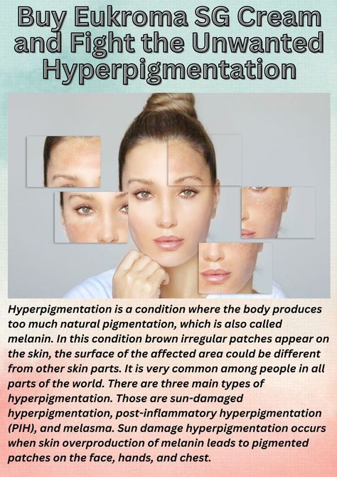 "Hyperpigmentation is a condition where the body produces too much natural pigmentation, which is also called melanin. In this condition brown irregular patches appear on the skin, the surface of the affected area could be different from other skin parts. It is very common among people in all parts of the world. There are three main types of hyperpigmentation. Those are sun-damaged hyperpigmentation, post-inflammatory hyperpigmentation (PIH), and melasma......... Post Inflammatory Hyperpigmentation, Be Different, Too Much, Sun, Cream, Skin