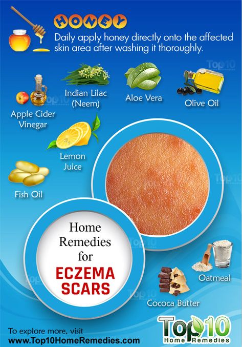 Remedies For Excema, Aloe Vera For Scars, How To Treat Excema, Treatments For Excema Natural Remedies, Excema Diet For Kids, Soap For Excema Sensitive Skin, Acne Scar Remedies, Top 10 Home Remedies, Anti Itch Cream