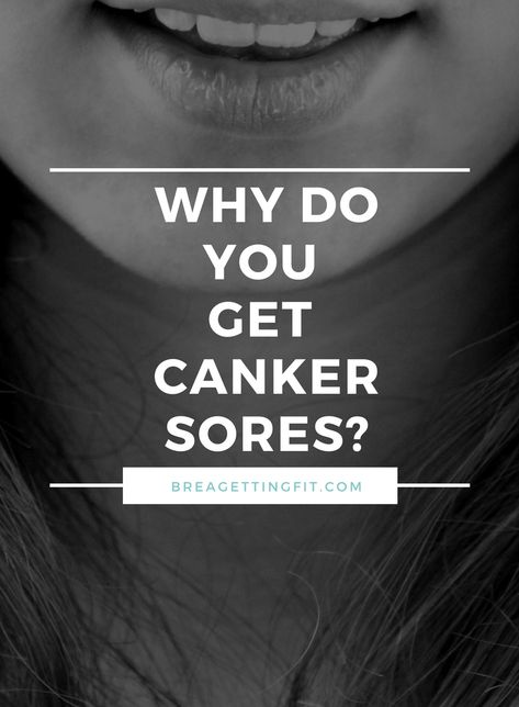 Blister In Mouth, Canker Sore On Tongue, Canker Sore Causes, Gum Sores, Canker Sore Relief, Mouth Blisters, Ulcer Remedies Mouth, Canker Sore Remedy, Tongue Sores