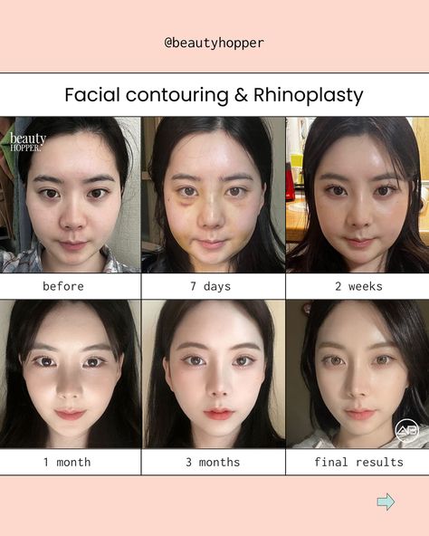 Changing your facial shape and proportion can be an extremely powerful tool to amplifying your beauty✨ For the above procedures, we recommend you to stay a minimum of 2 weeks in Korea. 👉🏻Whether you are seeking a subtle refinement or a more dramatic transformation, we can guide you to the best surgeon capable of achieving the aesthetic you desire. We’re here to help you have a safe and successful makeover in Korea. Contact us for a free consultation ⬇️⬇️⬇️ 💌: contact@beautyhopper.com 📲... Korean Plastic Surgery Before And After, Korean Nose Job, Korean Surgery, Kpop Plastic Surgery, Jaw Reduction Surgery, Nose Plastic Surgery, Plastic Surgery Korea, Plastic Surgery Fail, Korean Plastic Surgery