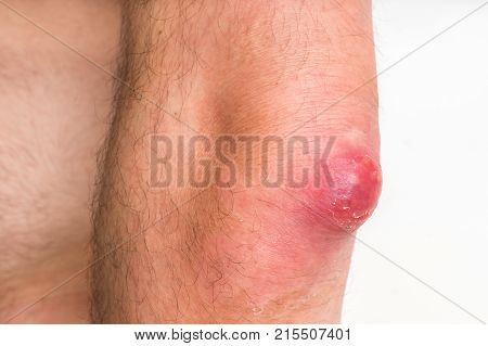 abscess,acne,arm,big,blemish,blister,boil,bump,carbuncle,care,caucasian,closeup,disease,elbow,excrescence,explode,furuncle,furunculus,hand,health,huge,infection,inflammation,lump,macro,male,man,medical,papula,papule,pimple,problem,pus,pustule,shocked,skin,surgery,teenage,teenager,whitehead,wound,zit Carbuncle Boil Remedies, How To Get Rid Of Boils In Private Area, Boils On Skin How To Get Rid Of A, How To Treat Boils Skin Remedies, Barnacles On Skin, Hand Health, Male Man, Bump, Surgery