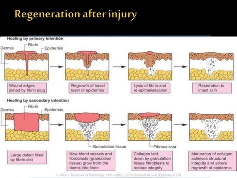 granulation tissue | WOUND HEALING AND ENDODONTICS Wound Documentation Nursing, Wound Healing Nursing, Wound Healing Stages, Wound Stages Nursing, Laceration Wound Care, Wound Classification, Granulation Tissue, Wound Care Nursing, Ayurvedic Healing