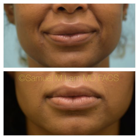 Heavy Upper Lip, Lip Reduction, Bottom Heavy, Facial Fillers, Lip Filler, Lower Lip, Lip Shapes, Upper Lip, Lip Fillers