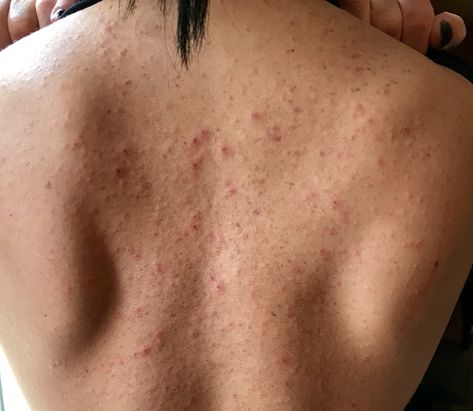 My Personal Story Of Allergic Contact Dermatitis – Diagnosis And Acceptance [Part 1] - Heather Mangieri Nutrition Red Rashes On Skin, Gluten Allergy Rash, Rash On Back, Skin Rashes Pictures, Home Remedies For Rashes, Ehlers Danlos Syndrome Symptoms, Rash Remedies, Allergy Rash, Itchy Skin Rash