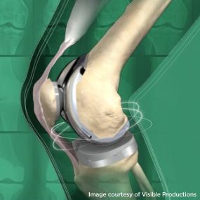 Step-by-Step Explanation of Knee Replacement Surgery Knee Replacement Surgery Recovery, Knee Replacement Exercises, Knee Replacement Recovery, Knee Operation, Knee Bones, Knee Pain Remedy, Knee Replacement Surgery, Knee Exercises, Knee Pain Relief