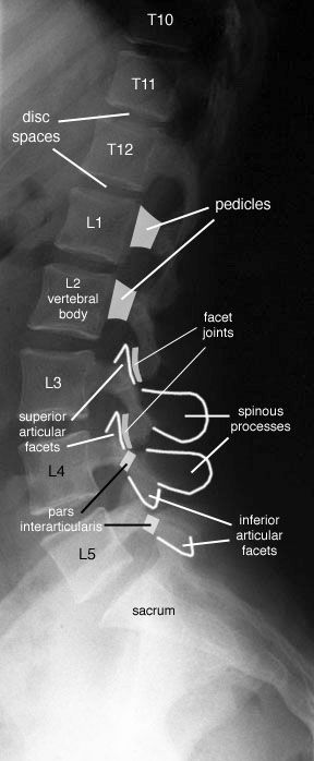 Lumbar Spine Xray, Xray Positioning, Radiographic Anatomy, Radiology Schools, Radiologic Technology, Radiology Student, Radiology Imaging, Radiology Technologist, Lumbar Spine