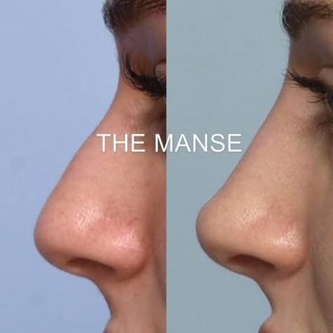 Luxury Clinic, Non Surgical Rhinoplasty, Nose Filler, Face Plastic Surgery, Nose Surgery Rhinoplasty, Nose Fillers, Upturned Nose, Parts Of The Nose, Rhinoplasty Nose Jobs